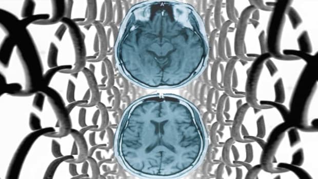 brain scan, MRI