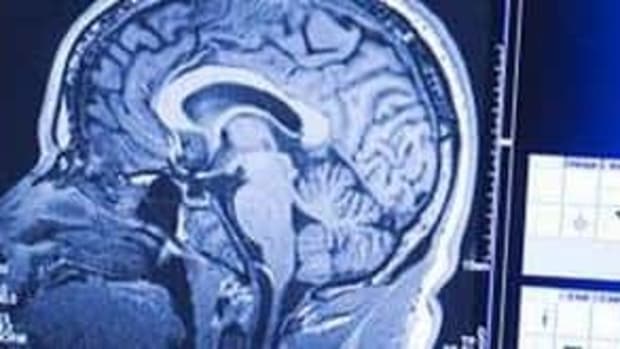 Study hints brain damage before symptoms show